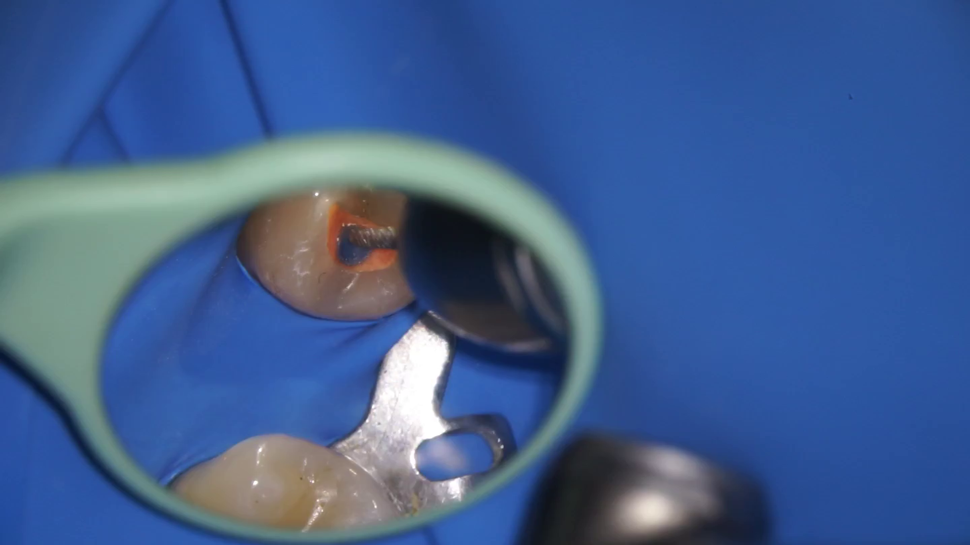Postendodontic build-up with fiber post